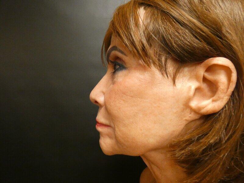 Facelift  Before & After Image