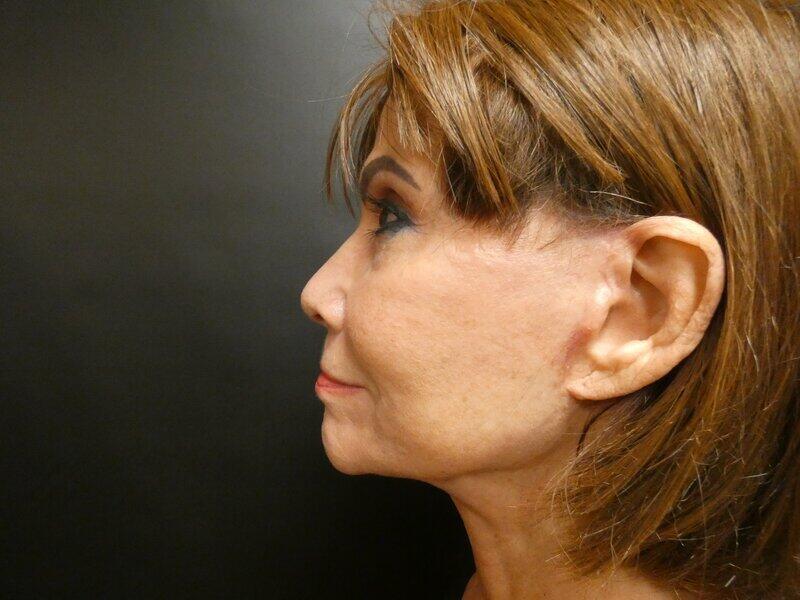 Facelift  Before & After Image