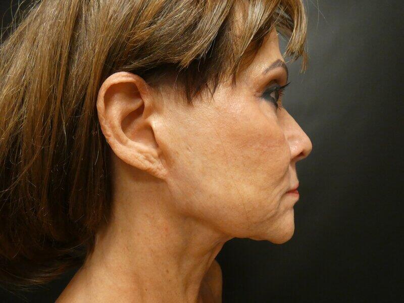 Facelift  Before & After Image