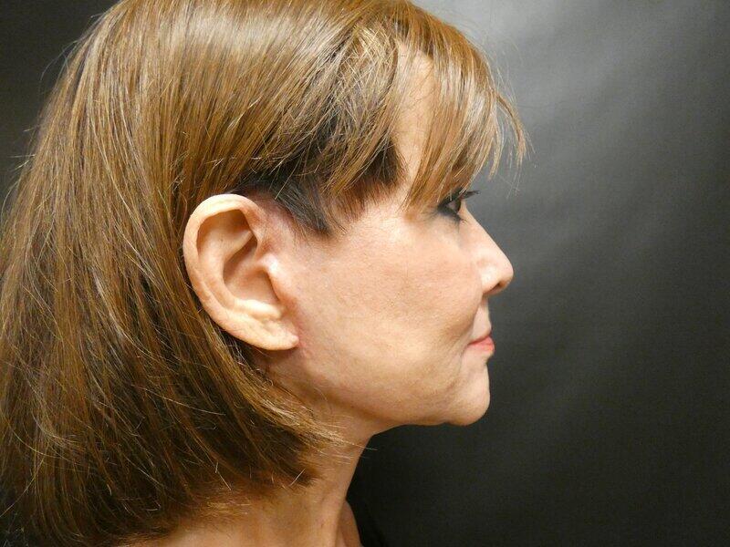 Facelift  Before & After Image