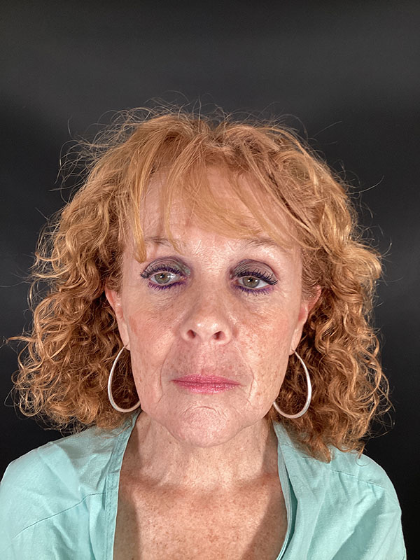 Facelift  Before & After Image