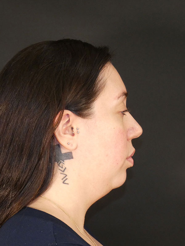 Facial Implants Before & After Image