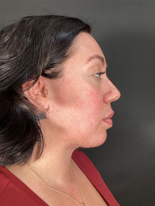 Facial Implants Before & After Image