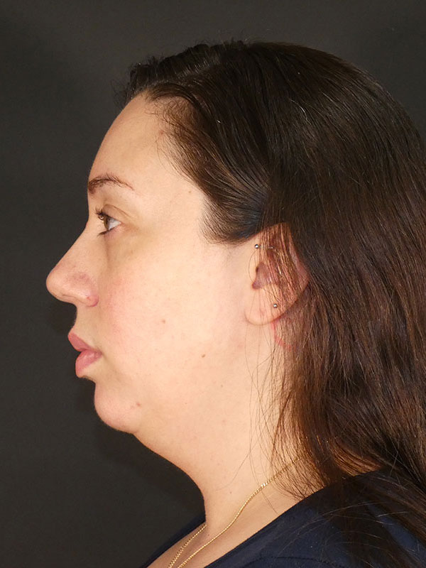 Facial Implants Before & After Image