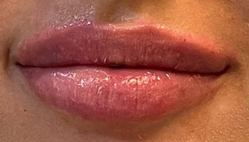 Lip Fillers Before & After Image