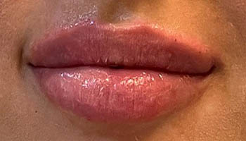 Lip Fillers Before & After Image