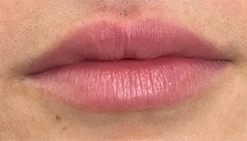 Lip Fillers Before & After Image