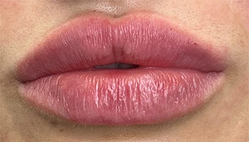 Lip Fillers Before & After Image