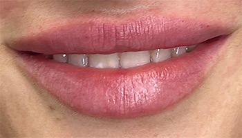 Lip Fillers Before & After Image