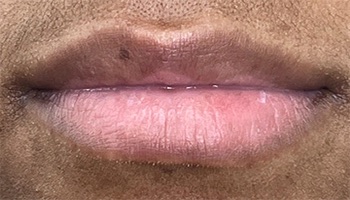 Lip Fillers Before & After Image