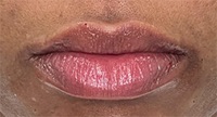 Lip Fillers Before & After Image