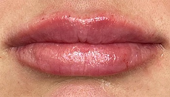 Lip Fillers Before & After Image