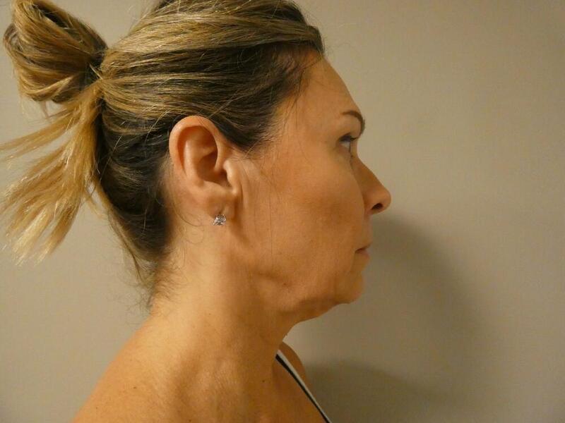 Neck Lift Before & After Image