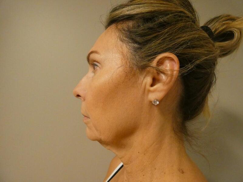 Neck Lift Before & After Image