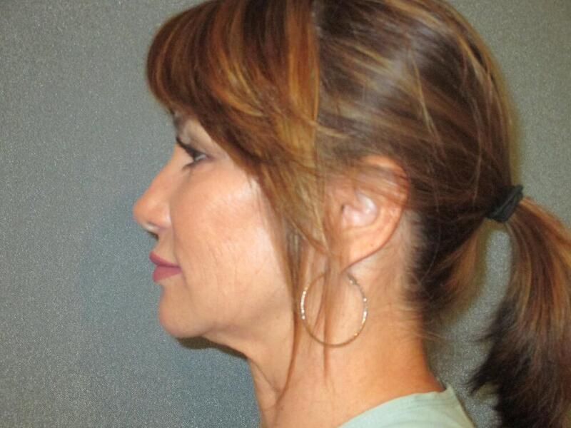 Neck Lift Before & After Image