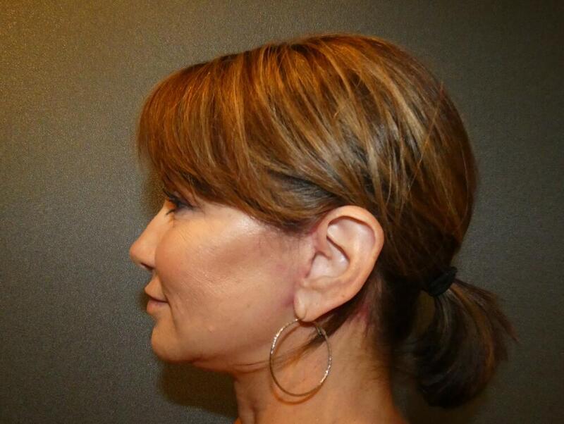 Neck Lift Before & After Image