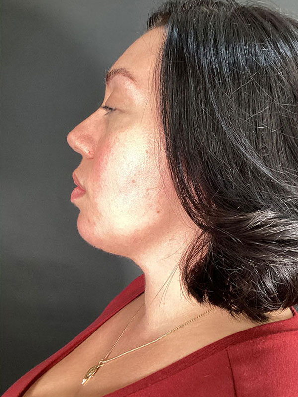 Neck Lift Before & After Image