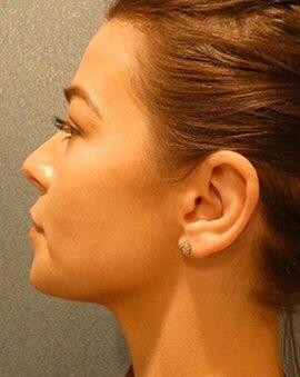 Ear Surgery Otoplasty  Before & After Image