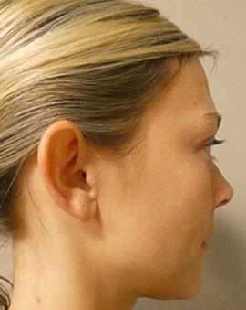 Ear Surgery Otoplasty  Before & After Image