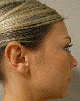 Ear Surgery Otoplasty  Before & After Image