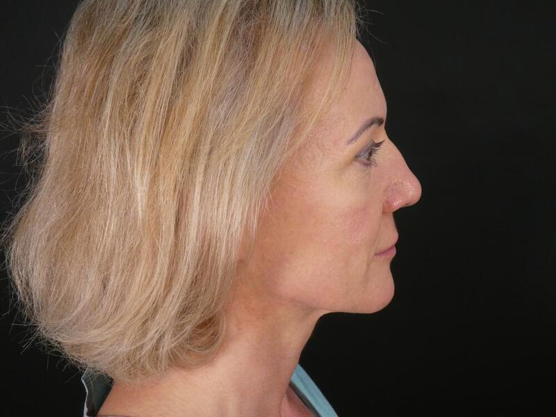 Rhinoplasty Before & After Image