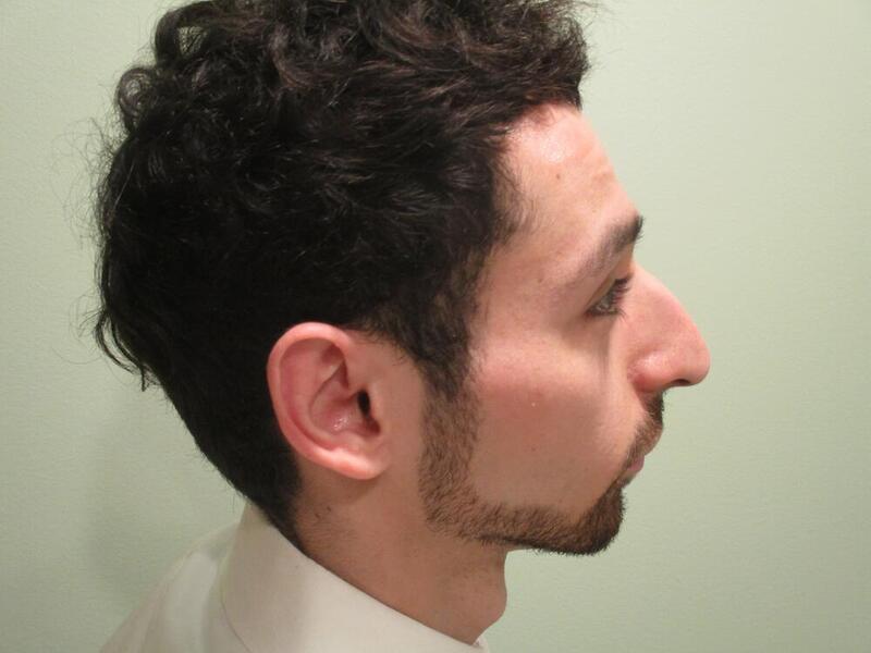 Rhinoplasty Before & After Image