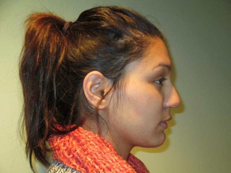 Rhinoplasty Before & After Image