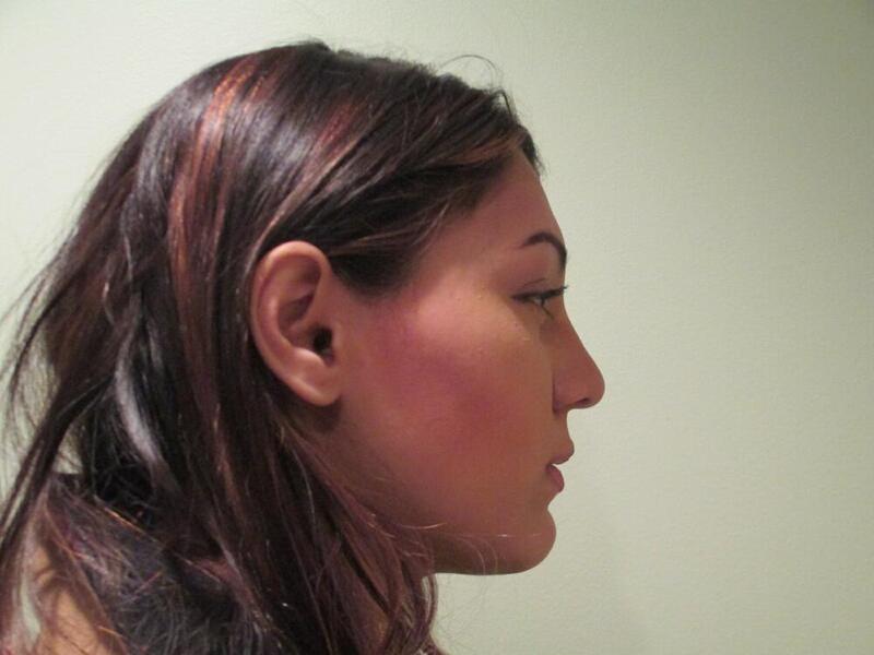 Rhinoplasty Before & After Image