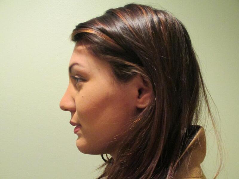 Rhinoplasty Before & After Image