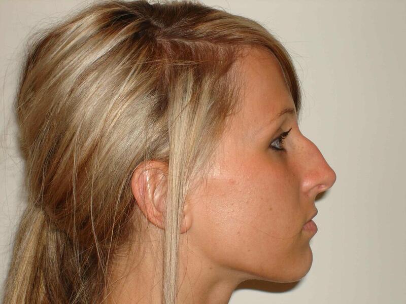 Rhinoplasty Before & After Image