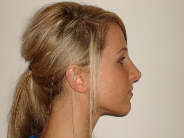 Rhinoplasty Before & After Image