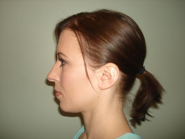 Rhinoplasty Before & After Image