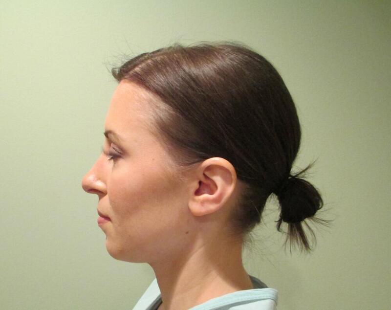 Rhinoplasty Before & After Image