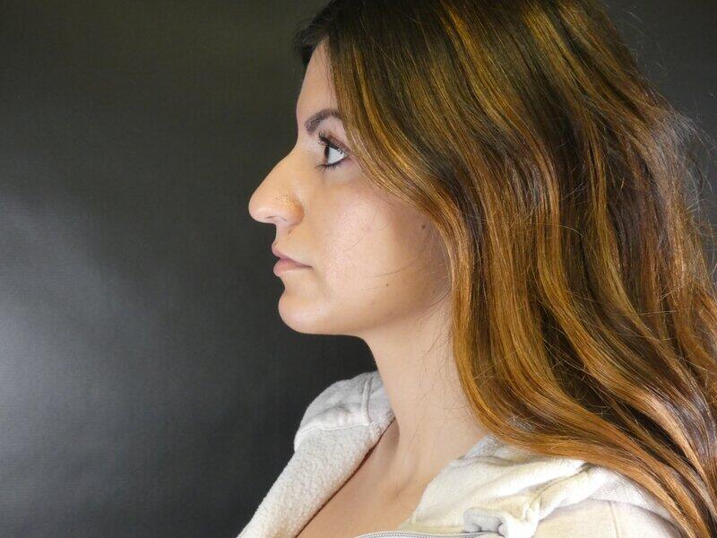 Rhinoplasty Before & After Image