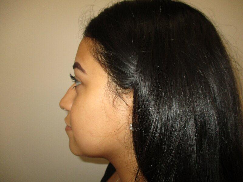 Rhinoplasty  Before & After Image