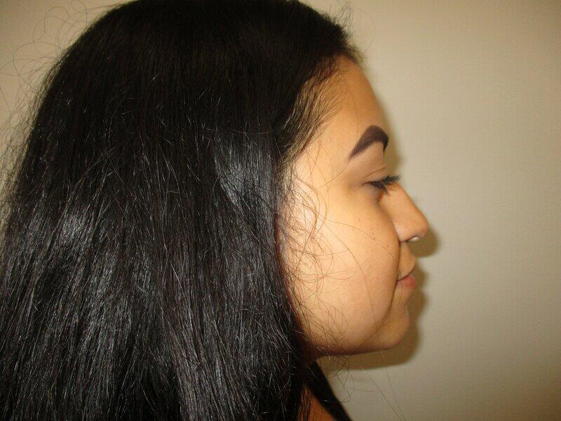 Rhinoplasty Before & After Image