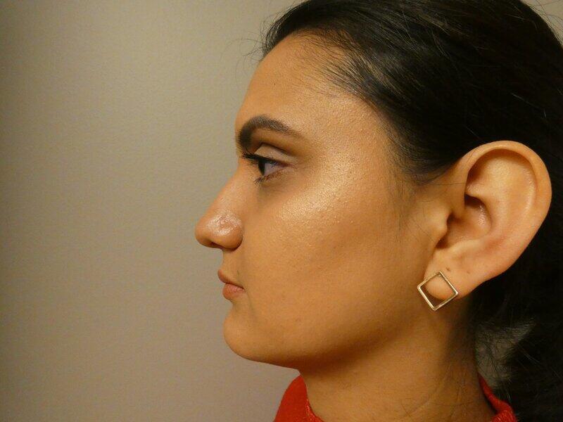 Rhinoplasty Before & After Image