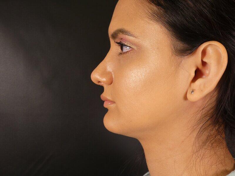 Rhinoplasty Before & After Image