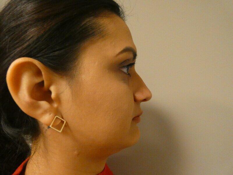 Rhinoplasty Before & After Image